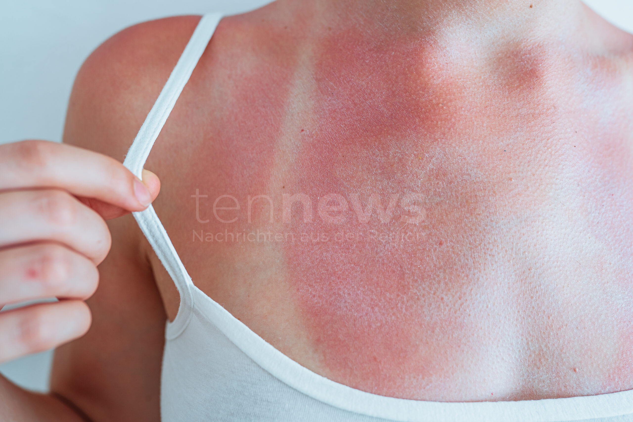 🔥 🧊 Sonnenbrand schnell lindern mit wirksamen Sofortmaßnahmen! Erfahren Sie, welche Hausmittel wirklich helfen und welche Mythen bei der Behandlung geröteter Haut besser vermieden.